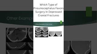 Which Type of Pneumocephalus Favors Surgery in Depressed Cranial Fractures [upl. by Niwre]