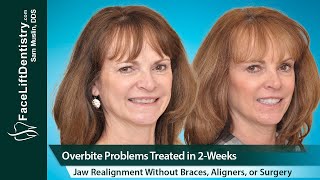 Overbite Problems Treated Jaw and Bite Realignment Without Braces Aligners or Surgery [upl. by Ljoka652]