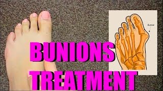 HOW TO TREAT BUNIONS AT HOME SolutionsRoom [upl. by Etteuqaj]