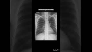 Bronchopneumonia xray radiology röntgen pneumonia [upl. by Larine]