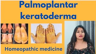 Palmoplantar keratoderma treatment  Palmoplantar keratoderma symptomscauses amp homeopathic medicine [upl. by Nadnarb865]