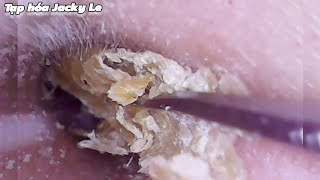 Ear Wax Removal 170 He was tormented by itchy ears every night  Ear Cleaning ASMR [upl. by Un]