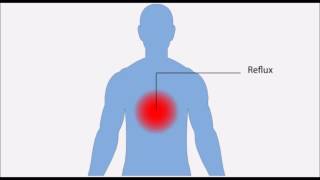 Oesophagite inflammation de l’oesophage [upl. by Tteirrah]