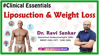 Liposuction and Weight Loss  DrRavi Sankar Endocrinologist MRCPUK CCT  GIM UK [upl. by Lil]