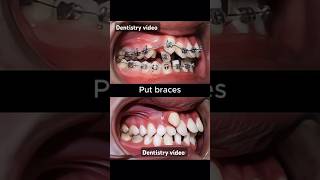 Braces are very crooked teeth braces orthodontist dentistry dentist allaboutbraces [upl. by Nayar]