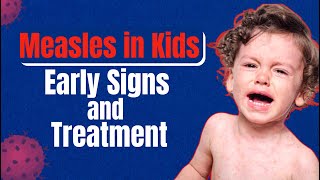 Measles Symptoms Treatment and Vaccination – Know all about it in this video [upl. by Eimirej]