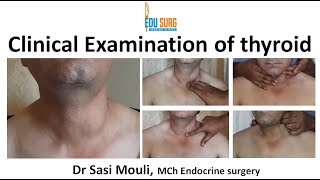 Clinical examination of thyroid swelling  An OSCE guide  MBBS MRCS  Surgery clinics [upl. by Gemperle]