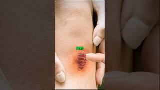 How to get rid of a scab shorts facts amazingfacts satisfying viralshorts viral [upl. by Katushka]