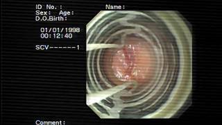 band ligation for Gastric antral vascular ectasia GAVE [upl. by Sana46]