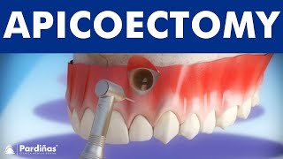 Apicoectomy  Treatment of root canal infection © [upl. by Einhapets]