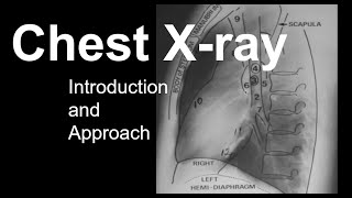 Chest Xray Introduction and Approach [upl. by Gamali]