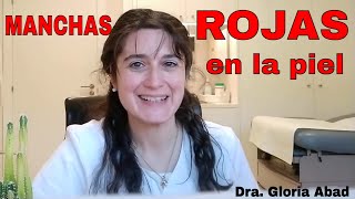 🔴 ¡MANCHAS ROJAS POR TODO EL CUERPO 🔴 PITIRIASIS ROSADA DE GIBERT  quotLa Rosadaquot [upl. by Ella]