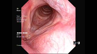 Vocal Fold Cystright with Vf noduleleft [upl. by Nogam813]