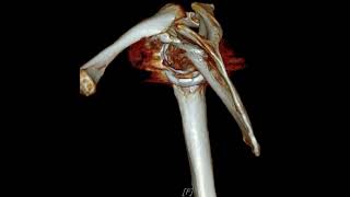 Acromion fracture after RTSA [upl. by Aneerhs]