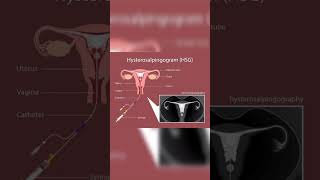 Hysterosalpingography  Salpingitis  Fallopian tube blockage  Nodular diverticulaeInfertility [upl. by Gerita]