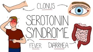 Serotonin Syndrome Explained Serotonin Toxicity [upl. by Gretna]