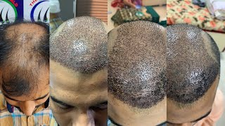 Hair transplant results in 10 days  Day by day hair transplant results [upl. by Soni]