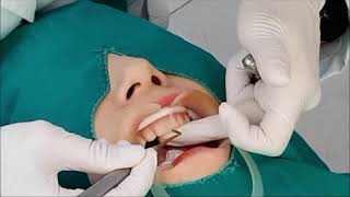 앞니레진 앞니레진 실시간 치료설명 Diastema resin closure real time anterior direct resin treatment [upl. by Utica]