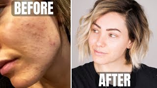 SKINCARE ROUTINE  acne prone skin [upl. by Leibarg]