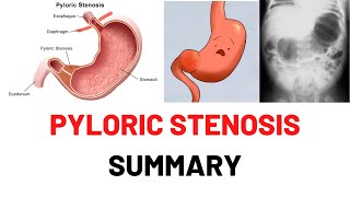 PYLORIC STENOSIS SUMMARY Causes Symptoms Signs Diagnosis Hypertrophic Pyloric Stenosis Lecture [upl. by Sand422]