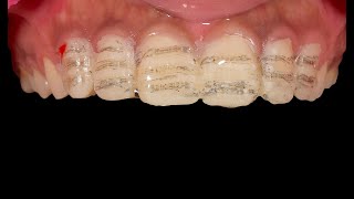 Step by Step Veneer Preparation And Cementation  EMAX Porcelain Veneer  Clinical case [upl. by Odey237]