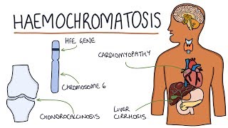 Understanding Haemochromatosis [upl. by Smail]