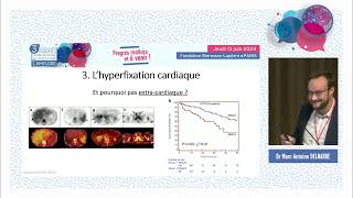 La scintigraphie osseuse dans l’amylose à transthyrétine  intérêt et limites [upl. by Rafaelita]