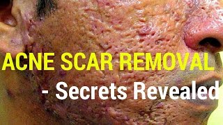 How to treat acne scars Dermatology Secrets revealed [upl. by Blodget747]