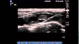 supraclavicular brachial plexus block pediatric [upl. by Junji503]