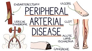 Understanding Peripheral Arterial Disease [upl. by Assirk]