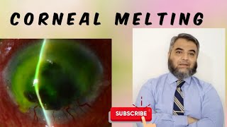 CORNEAL MELTING [upl. by Wardle]