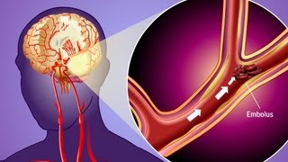 Stroke Prevention amp Transient Ischemic Attack TIA [upl. by Aliber91]