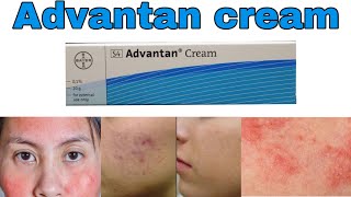 Advantan cream uses and benefits methylprednisolone side effects How to use for skin infections [upl. by Harewood814]