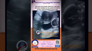 Subserosal myoma with pregnancy ultrasoundtraining ultrasound ultrasoundcourse [upl. by Barbara]