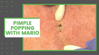 Pimple Popping with Mario  Dr Derm [upl. by Miner]