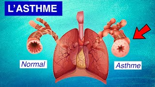 Asthme bronchique  Physiopathologie Symptômes et Traitements [upl. by Elaynad]