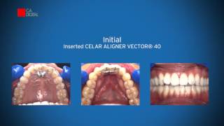 Clinical Case  CA CLEAR ALIGNER [upl. by Nelleoj400]