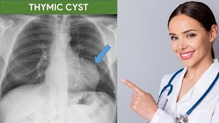 Thymic Cyst in Chest Xray amp CT Scan [upl. by Sylvia]