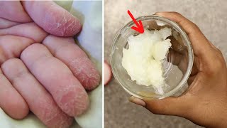 Fix dry severely cracked hands and skin peeling from fingers naturally at home [upl. by Hartill558]