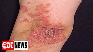 Psoriasis les meilleurs remèdes naturels  CDT NEWS [upl. by Llewkcor]