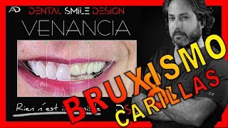 👄 Carillas Dentales en dientes desgastados por bruxismo y con Bifosfonatos  Antes y Despues  DSD [upl. by Hameean132]