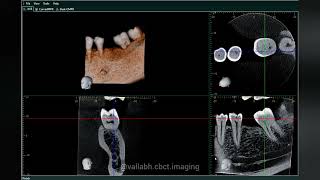 CBCT ANATOMICAL LANDMARK SECTIONAL MANDIBLE [upl. by Watters]