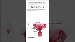 Endometriosis [upl. by Aynav]