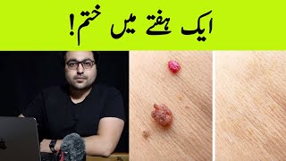 Dr ZeeHow to Rid Skin Tags and Warts  Quick fix  त्वचा के तिल [upl. by Eignav]