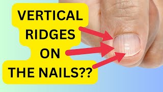 Do you have Vertical Nail Ridges Causes amp Treatment simplified [upl. by Dhaf]