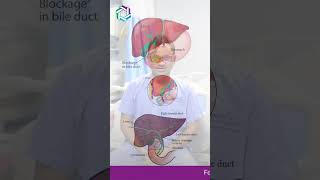 How Does PTBD Differ from ERCP in Accessing Bile Ducts  Dr praveen Kammar Mumbai [upl. by Oivlis475]