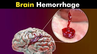 What Happens in Brain Hemorrhage  Symptoms Causes and Treatment UrduHindi [upl. by Adnovaj]