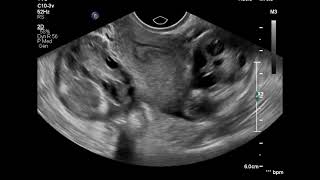 Bilateral salpingitis ultrasound [upl. by Ailama]