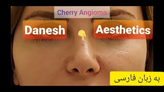 چطور می‌توان خال قرمز رنگ یا توده عروقی خوش خیم پوستی را ظرف کمتر از یک دقیقه برداشت؟ [upl. by Zelazny]