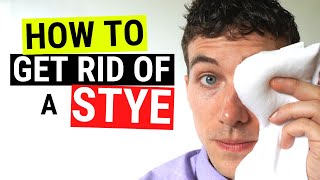 How to Get Rid of a Stye FAST  Chalazion VS Stye Treatment [upl. by Iaras]